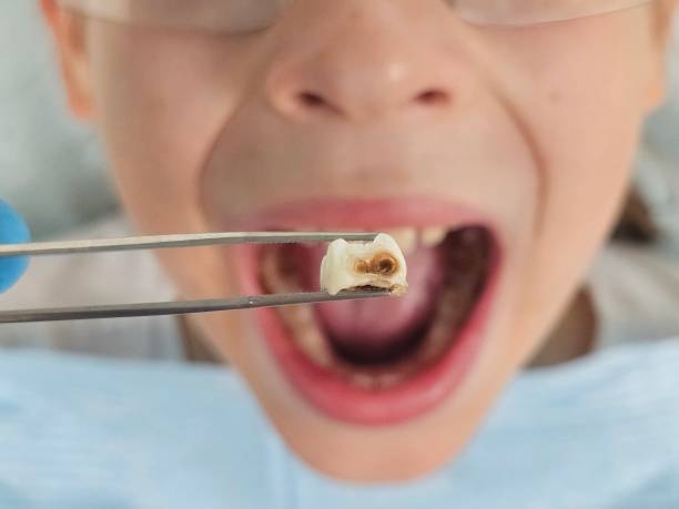 Best Knocked-Out Tooth (Avulsed Tooth) Treatment in Home Garden, CA